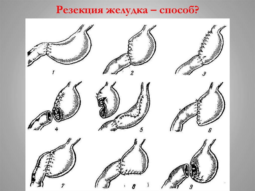 Резекция желудка картинки