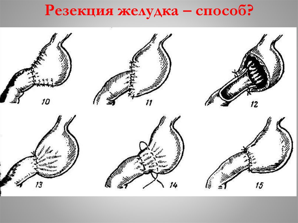 После резекции желудка. 