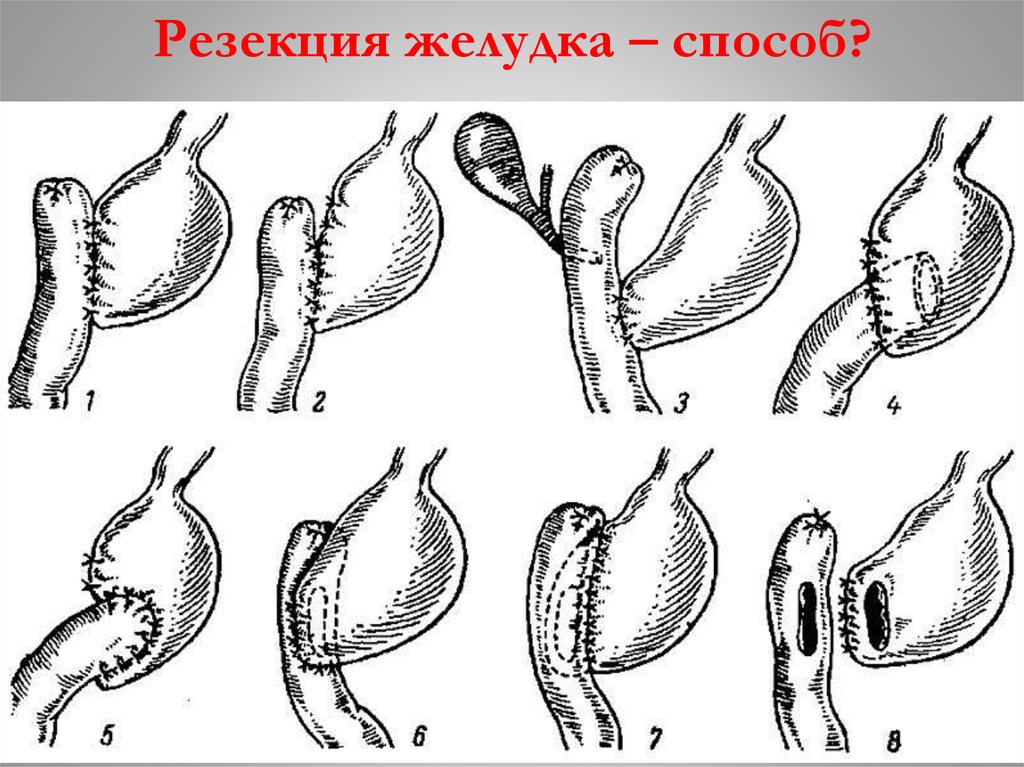 Резекция желудка. Операция по резекции желудка. Продольная резекция желудка схема. Способы резекции желудка.