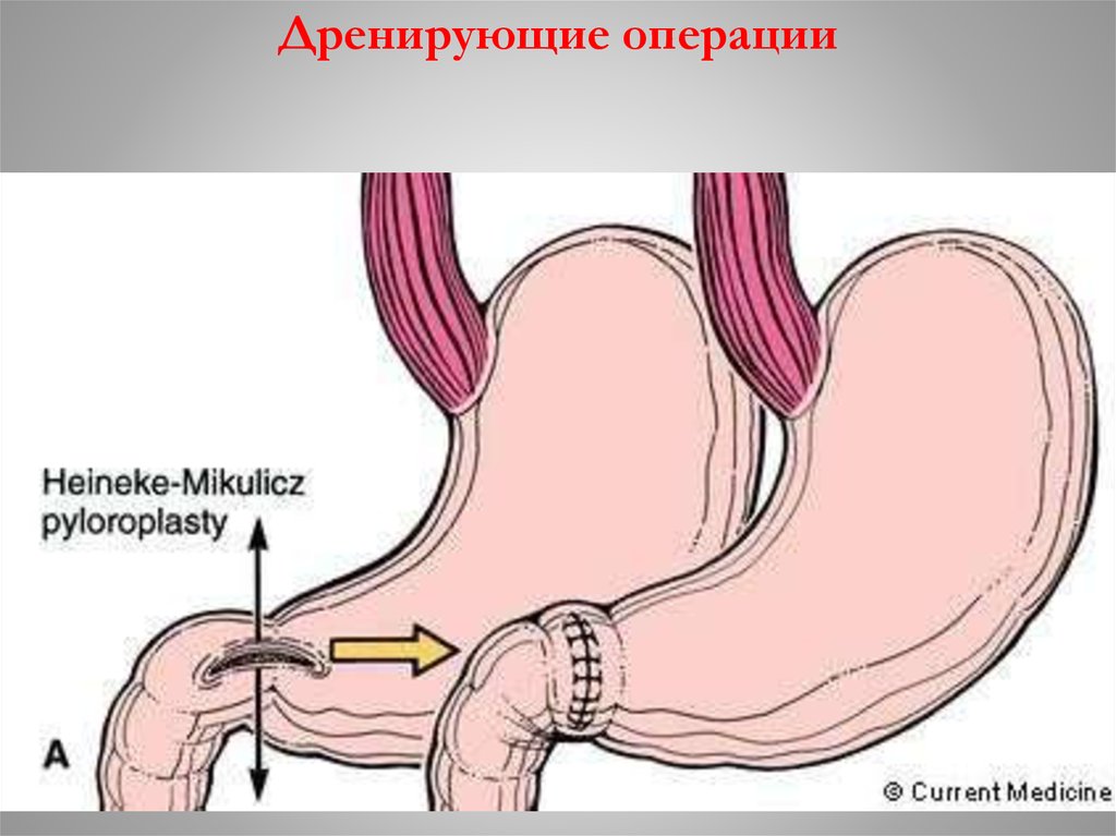 схема проточно-промывной системы для диализа раны. дренирующие операции на желудке. дренировать. дренирующие операции на желудке. дренирующие желудок операции по джабулею.