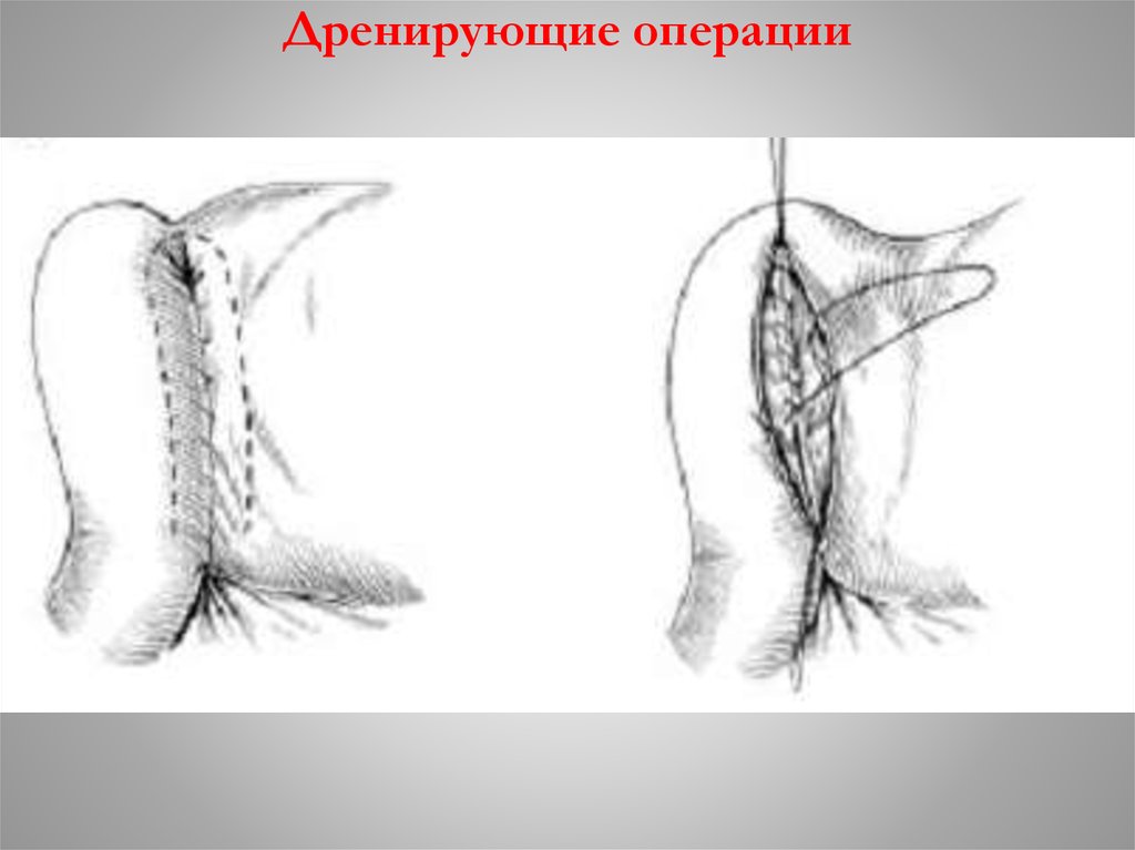 Дренирующие операции