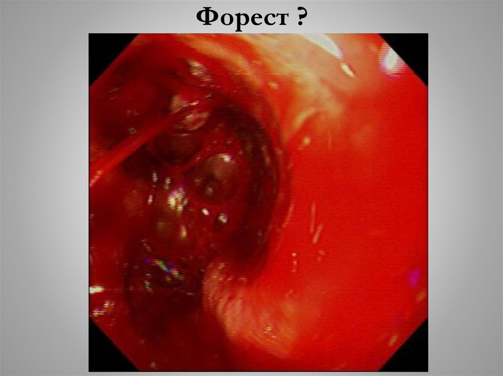 Форест ?