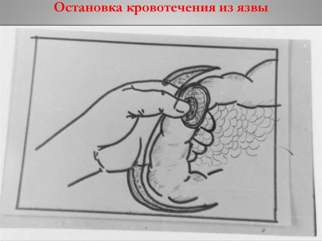 Остановка кровотечения из язвы