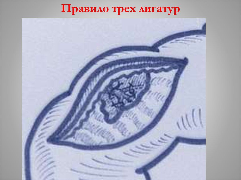 Правило трех лигатур