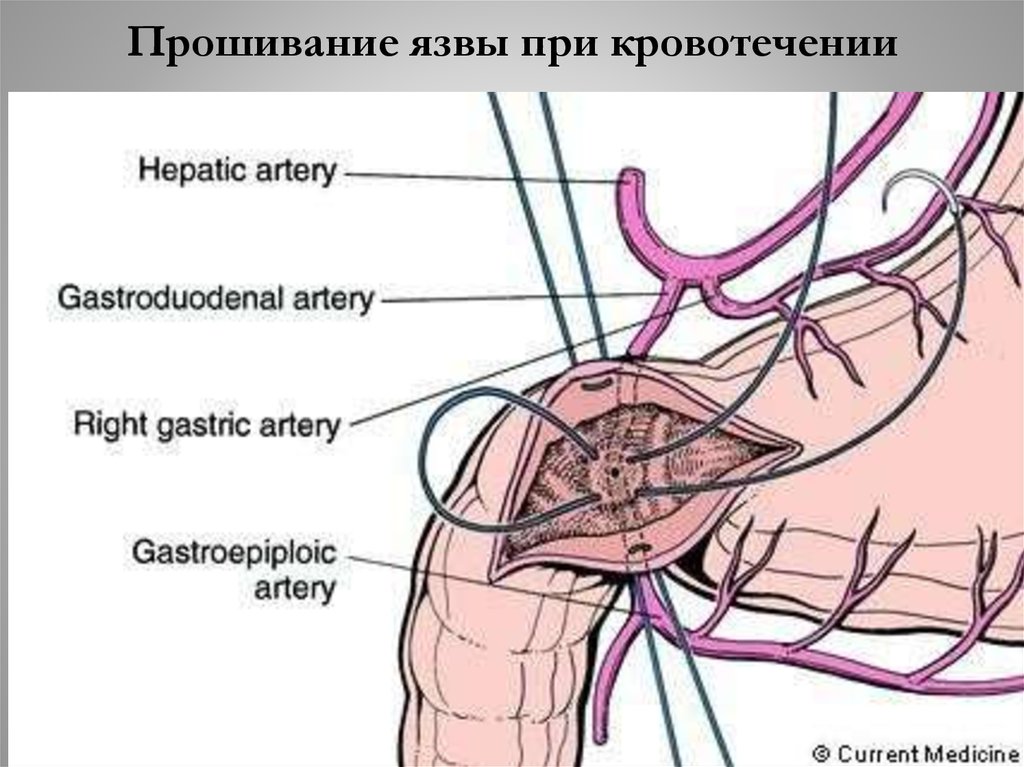 Прошивание язвы при кровотечении