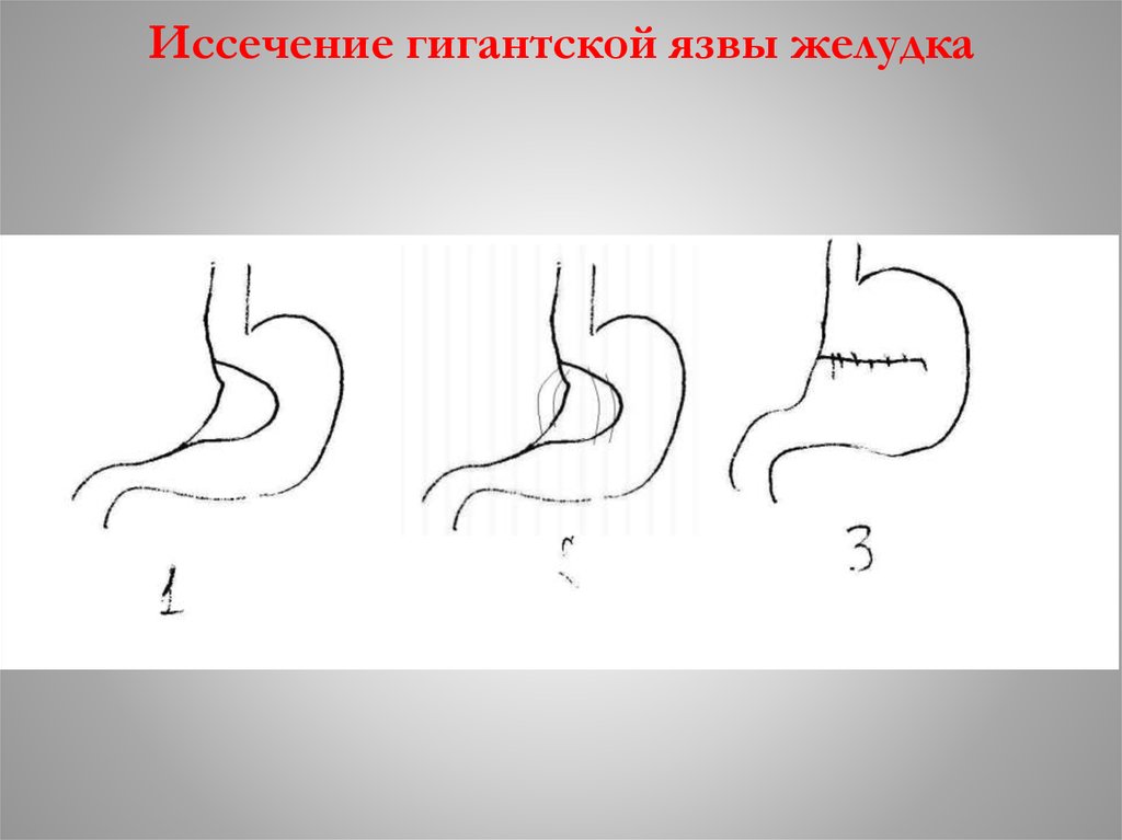 Пилоропластика по финнею схема