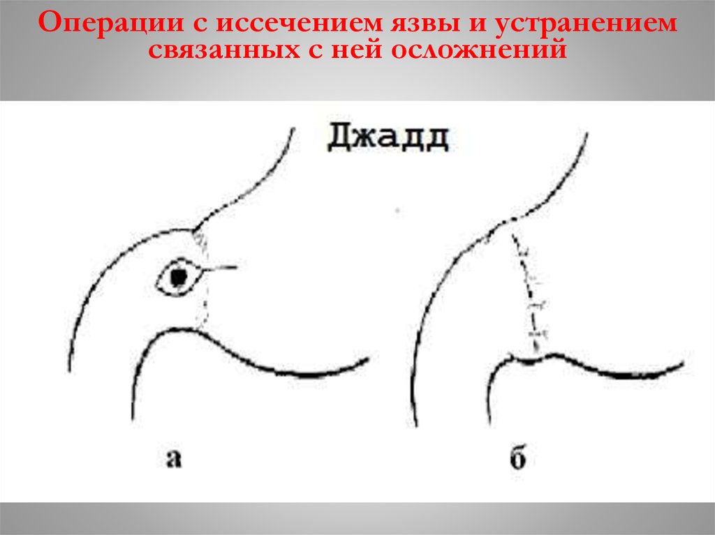 Пилоропластика по финнею схема