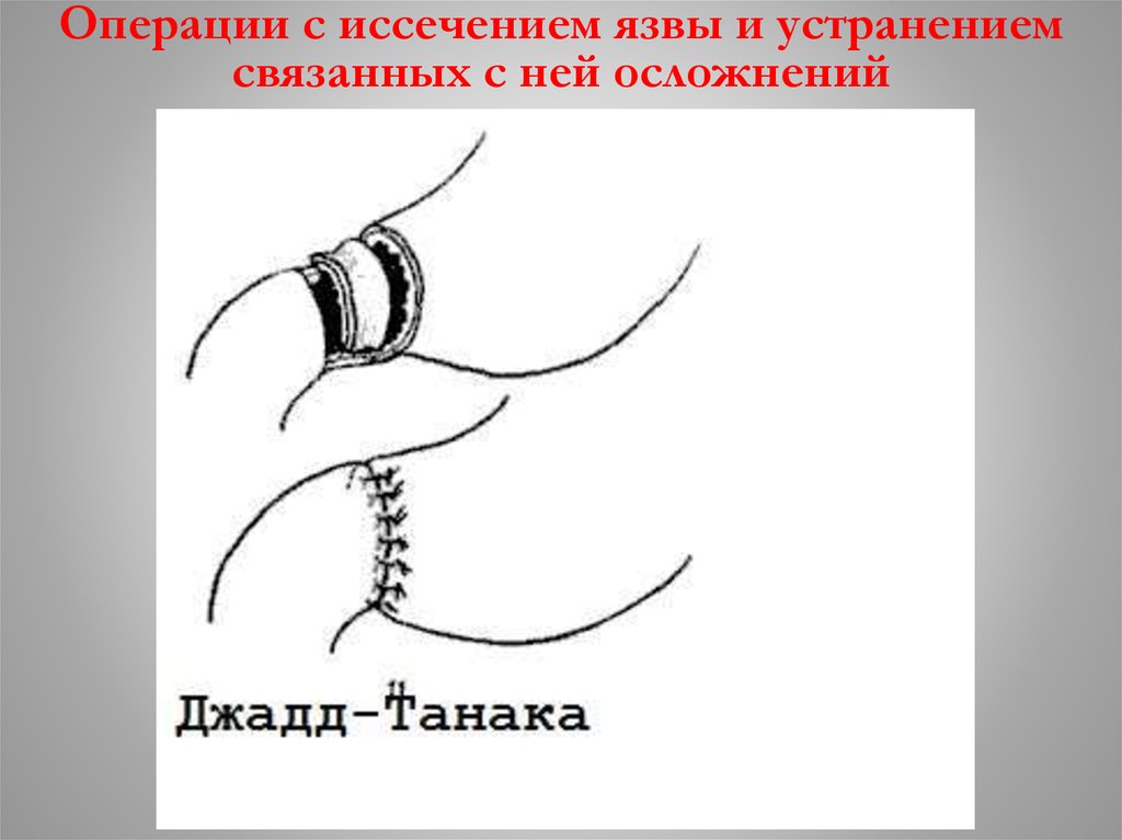 Операции с иссечением язвы и устранением связанных с ней осложнений