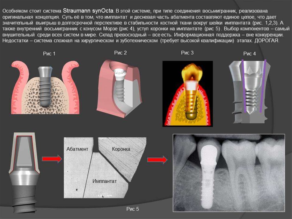 Особенности протезирования с использованием различных систем имплантатов презентация