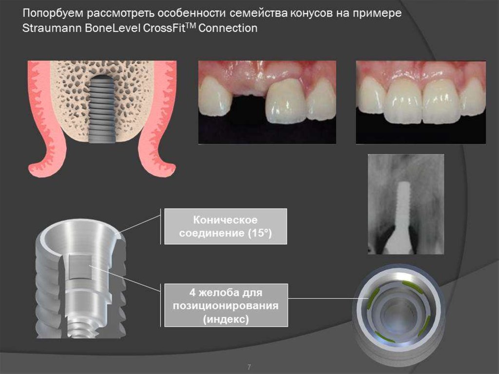 Презентация по имплантации