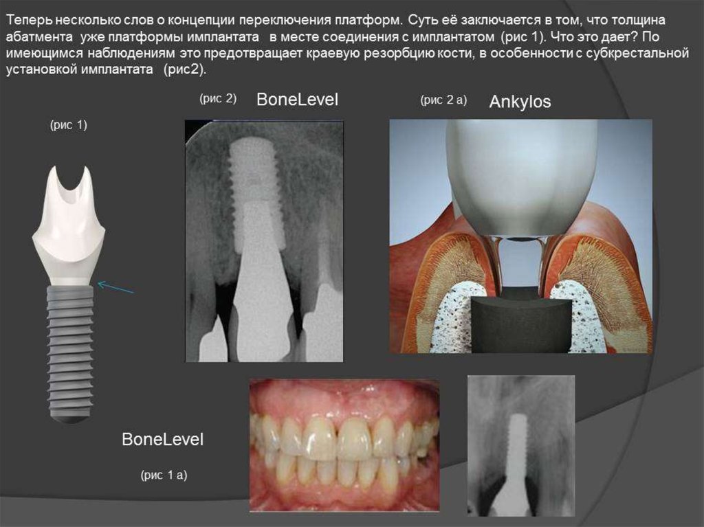 Имплантация sup aznona com. Этапы имплантации зубов. Имплантология для чайников. Современная имплантация. Дентальные имплантаты с эффектом переключения платформ.