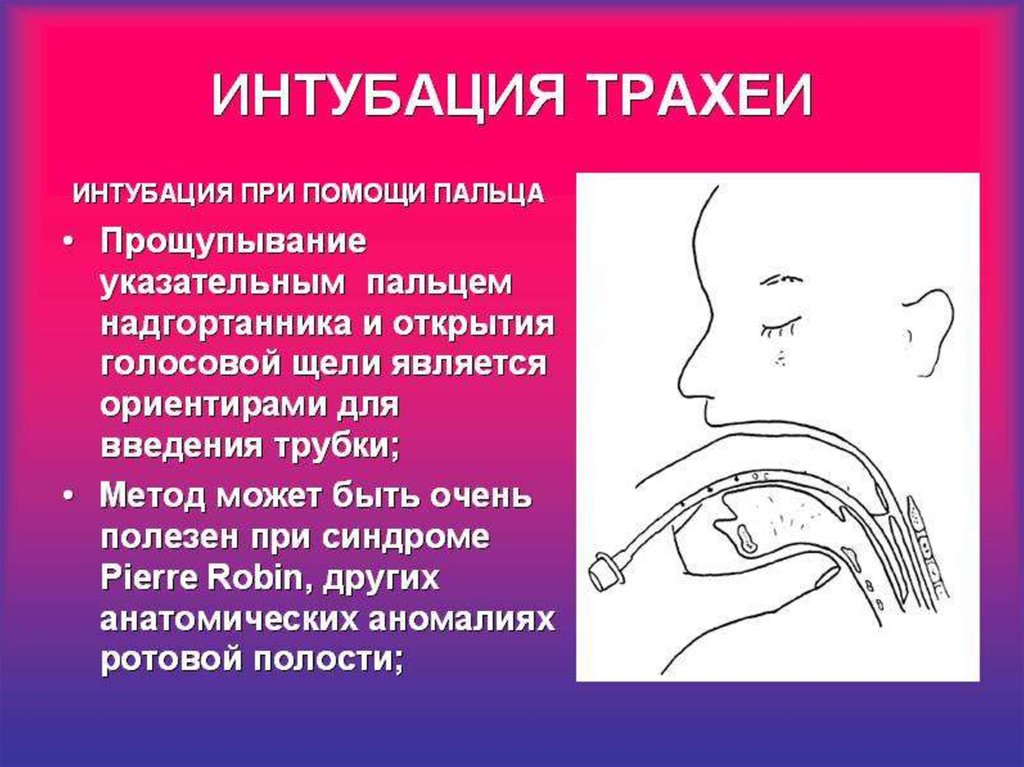 Интубация трахеи. Реанимация интубация трахеи. Голосовая щель при интубации трахеи.