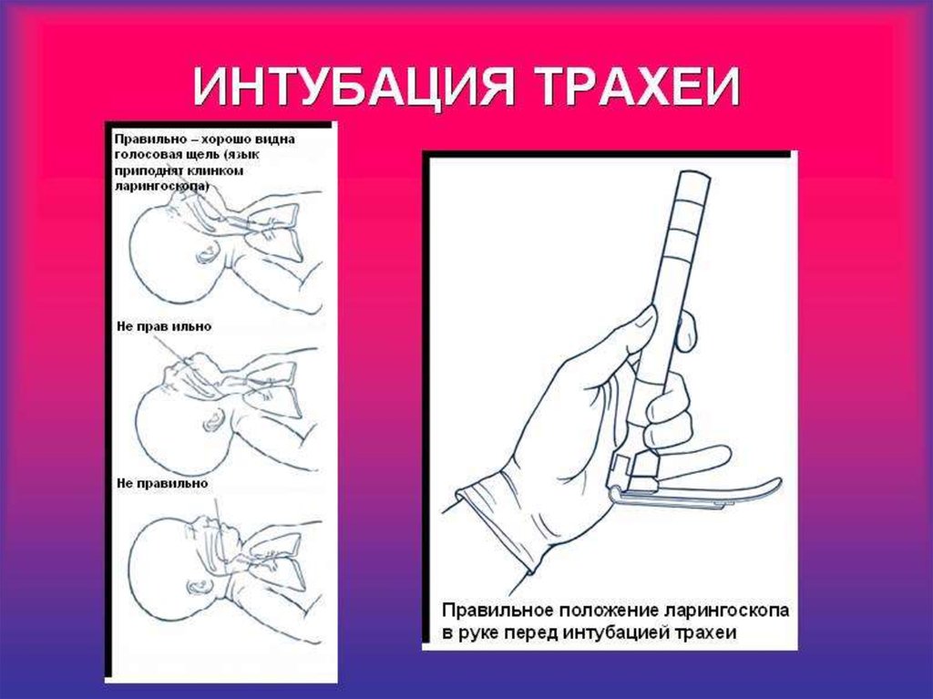 Интубация трахеи презентация