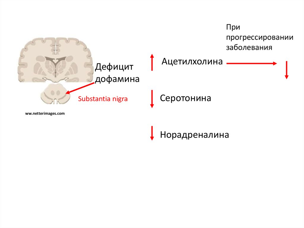 Нехватка дофамина симптомы. Болезнь Альцгеймера ацетилхолин. Дефицит ацетилхолина. Ацетилхолин и дофамин. Дефицит дофамина.