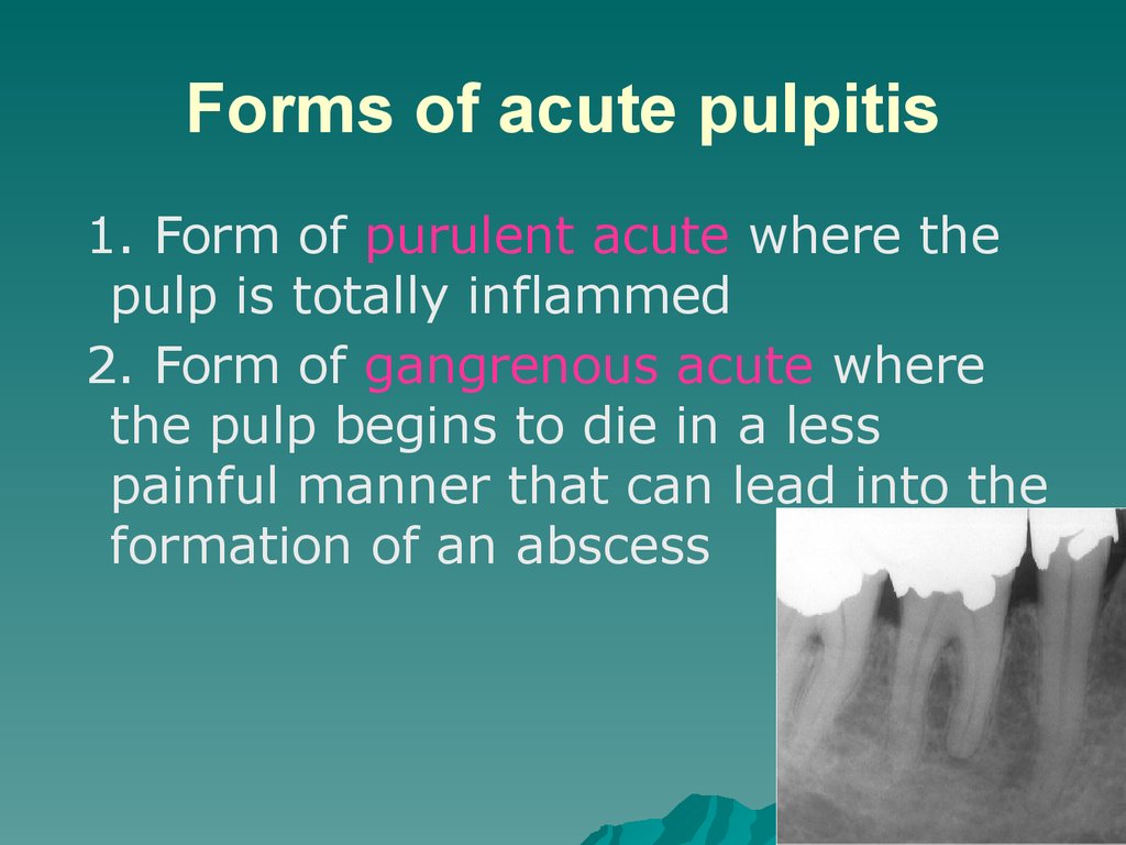 Forms of acute pulpitis