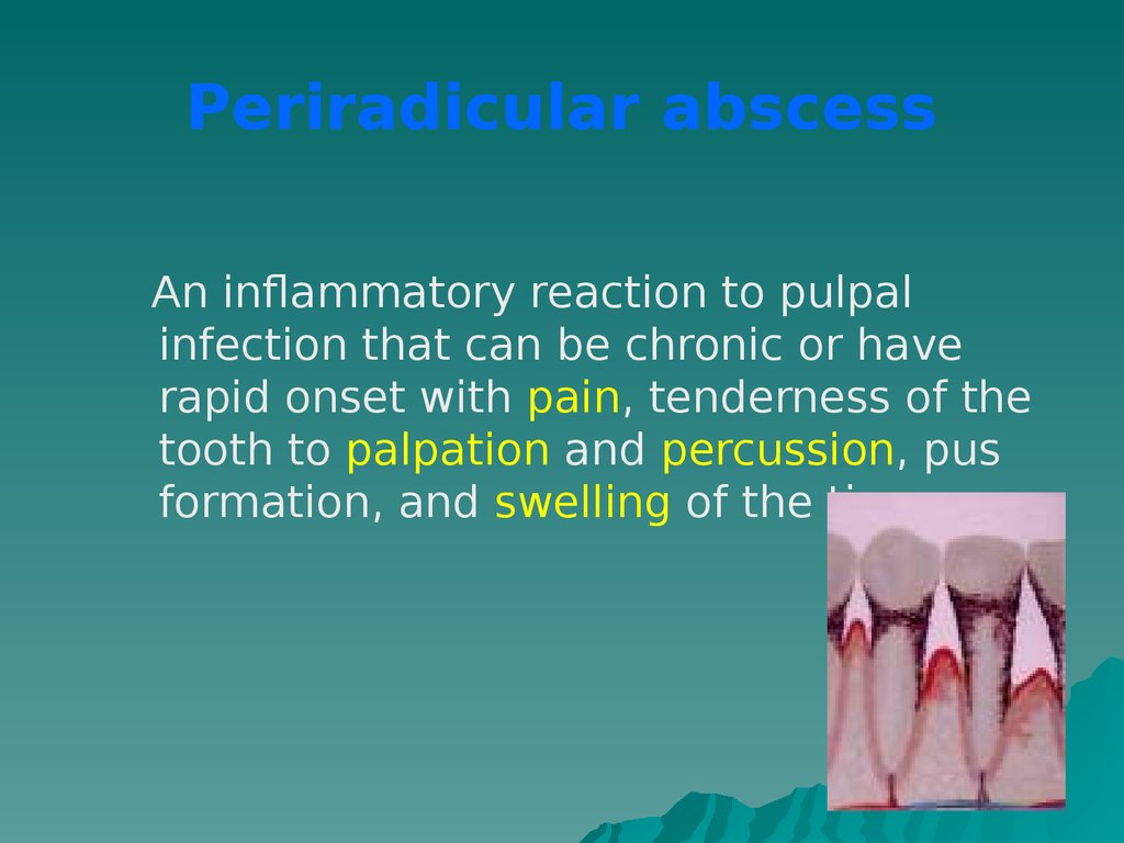 Periradicular abscess