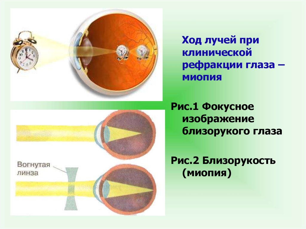 Ход лучей глаза человека. Рефракция глаза миопия. Ход лучей при различной клинической рефракции глаза. Миопия рис. Близорукость ход лучей.