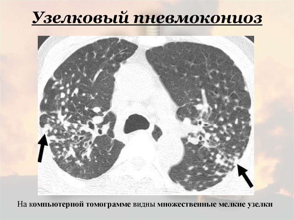 Клиническая картина карбокониозов