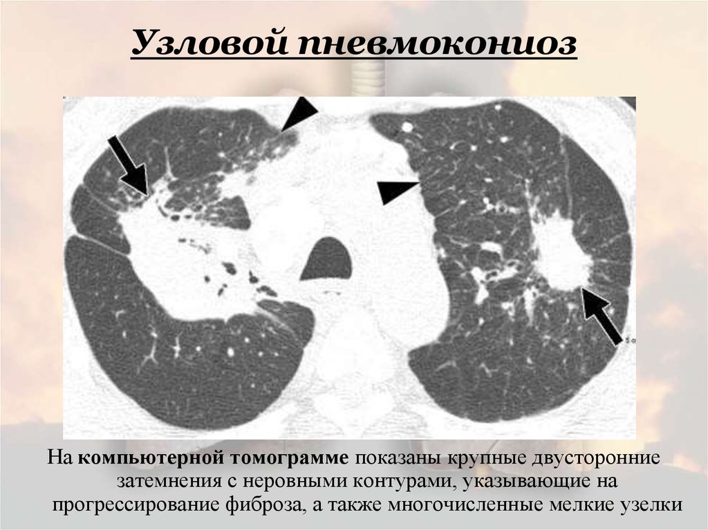 Пневмокониоз. Пневмокониоз легких кт. Пневмокониоз кт картина. Силикоз легких на кт. Узловая форма пневмокониоза.