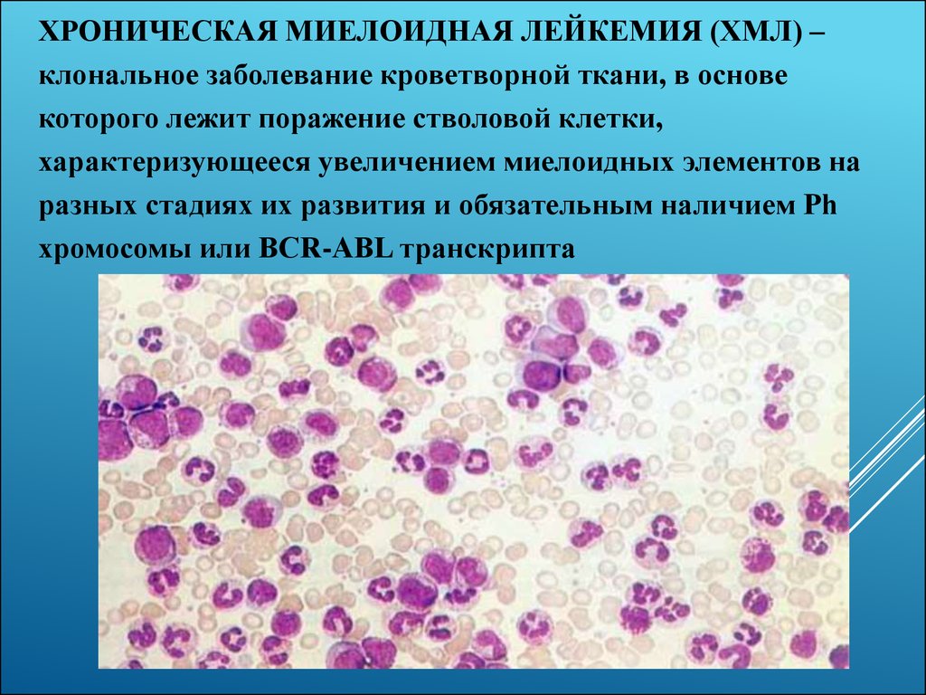 Картина крови при хроническом миелолейкозе