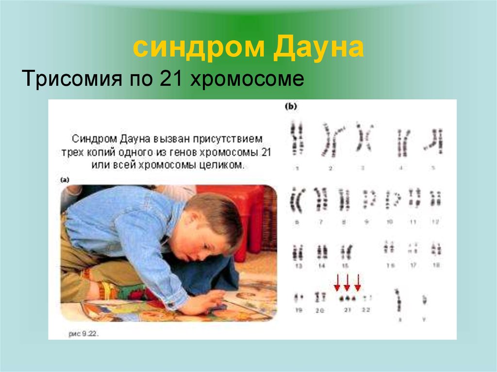 Хромосомы у дауна. Синдром Дауна трисомия по 21. Трисомия в 21 паре хромосом. Трисомия по 21 хромосоме. Синдром Дауна трисомия по 21 хромосоме.