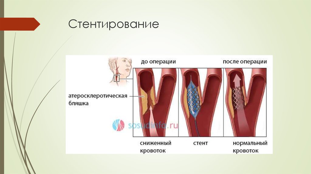 Протезирование сосудов презентация