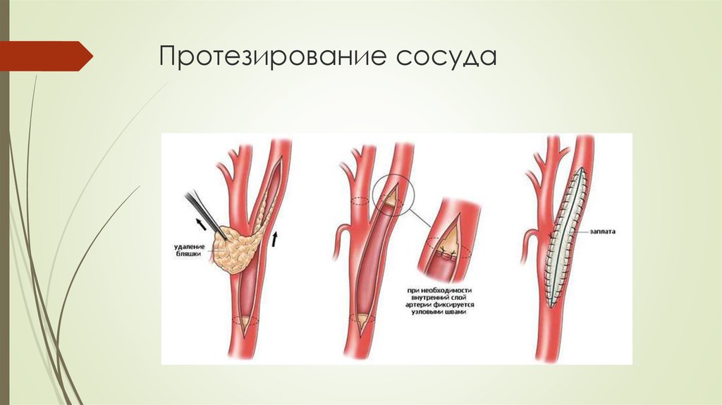 Артерия ноги операция. Аневризма бедренной артерии операция. Шунт бедренной артерии. Шунтирование и протезирование сосудов. Аорто бедренное шунтирование анатомия.