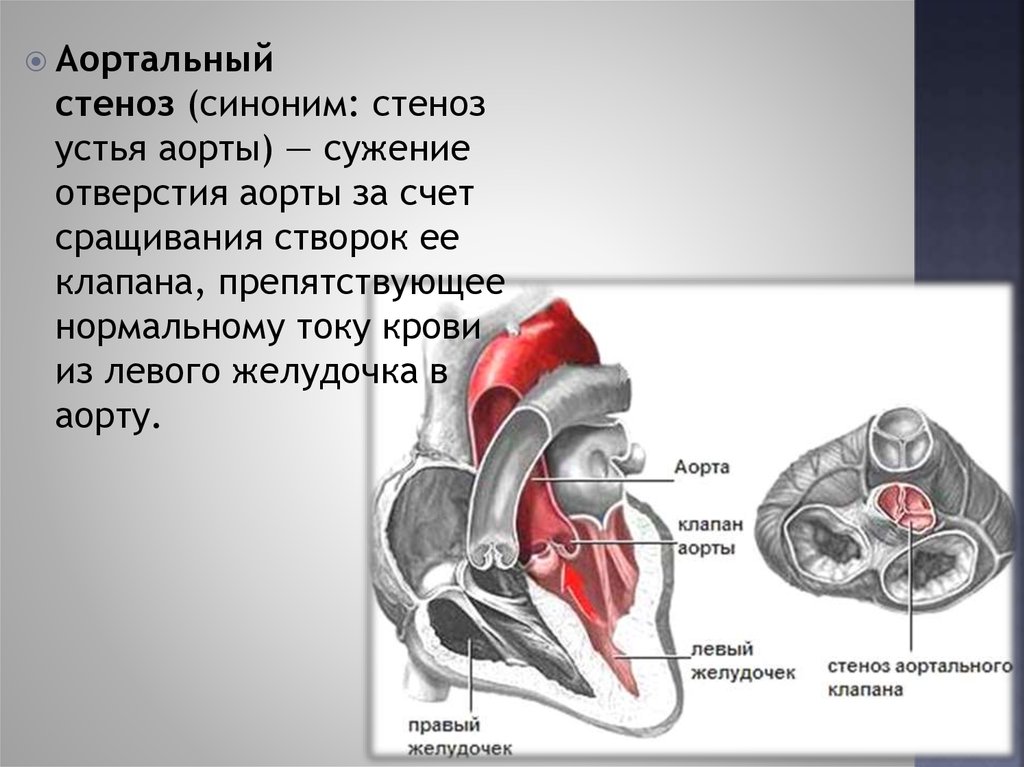 Аортальный стеноз что это такое. Стеноз устья аорты и аортальный стеноз. Стеноз аортального отверстия. Отверстие аортального клапана.