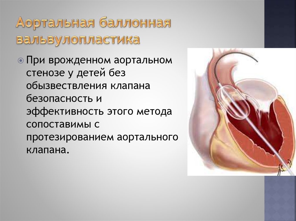 Аортальный стеноз презентация