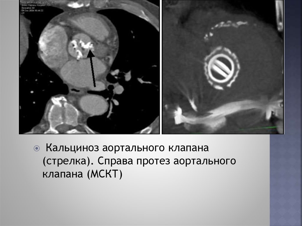 Кальцинаты в стенках аорты