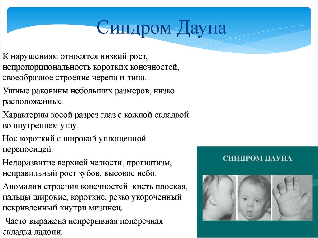 Фенотип ребенка с синдромом дауна. Характерные проявления синдрома Дауна. Симптомы синдрома Дауна кратко.