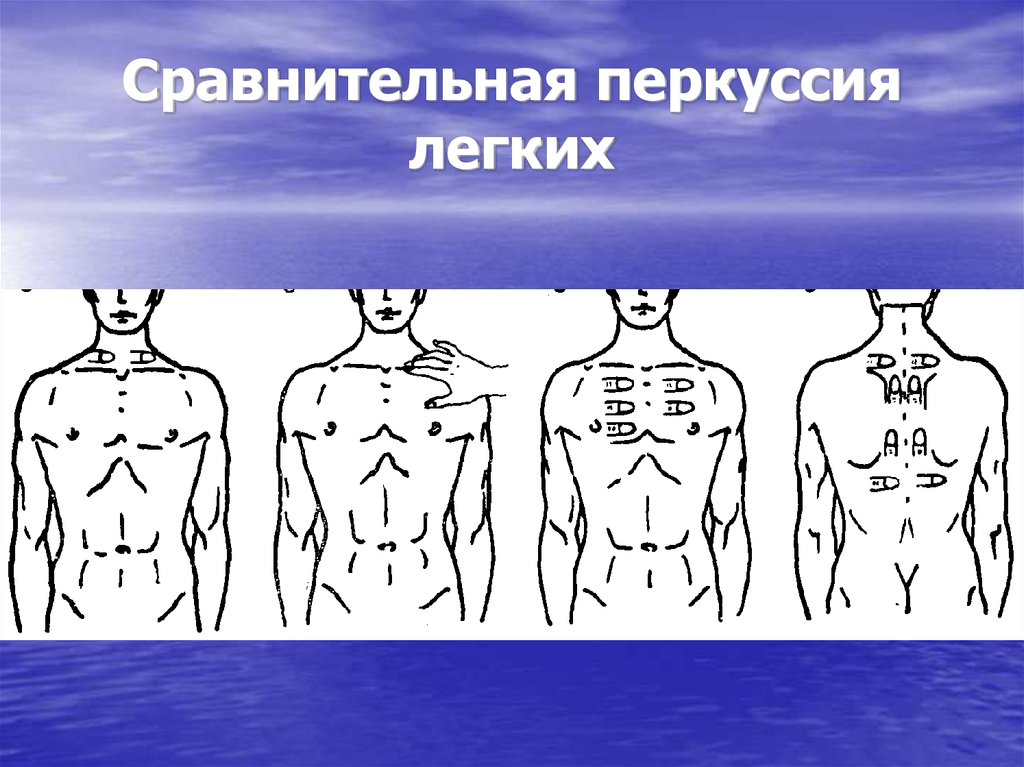 Схема сравнительной перкуссии легких