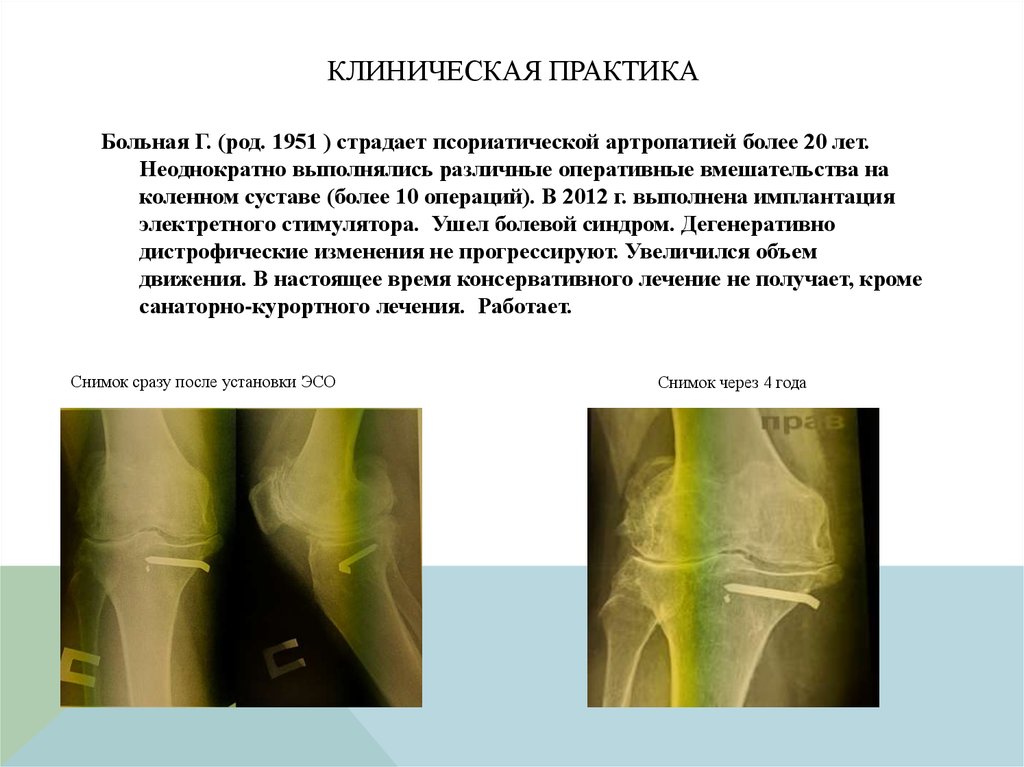 Лечение деформирующего