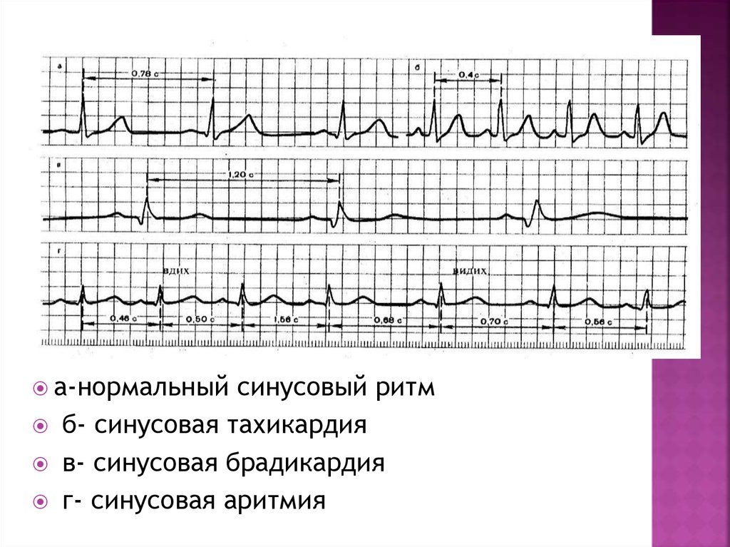 Что значит синусовый ритм сердца на экг. ЭКГ при синусовой аритмии. ЭКГ при синусовой тахикардии синусовой брадикардии. ЭКГ синусовая тахикардия брадикардия аритмия. Синусовая брадикардия на ЭКГ.