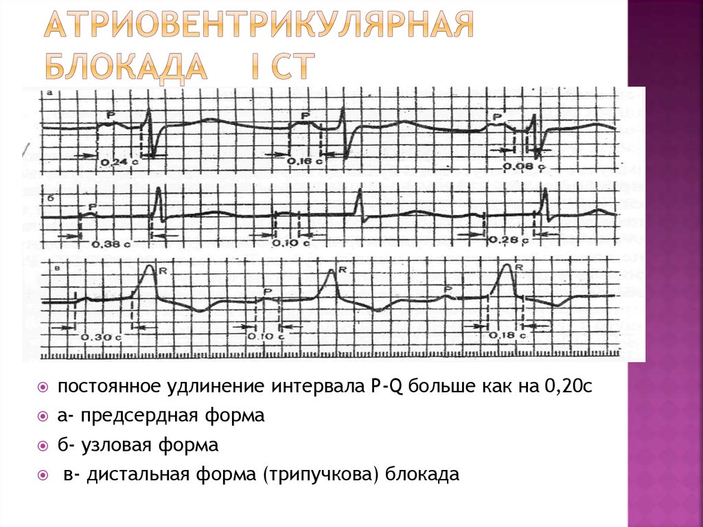 Ав блокада 1 степени