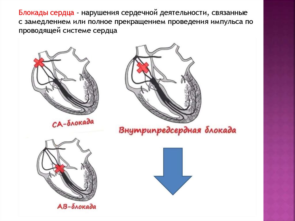 Блокада сердца это опасно. Блокада сердца. Проводящая система сердца. Блокада проводящей системы. Блокада проведения импульсов в сердце.