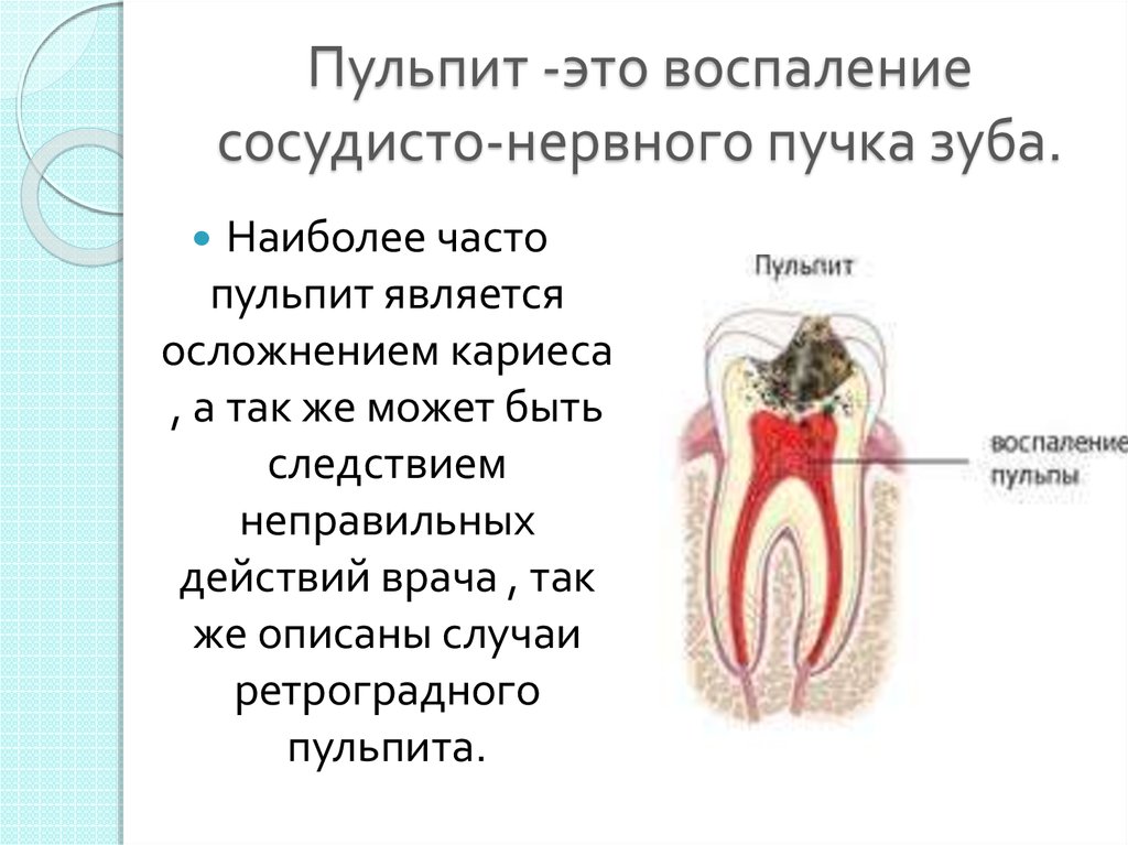 Острый очаговый пульпит презентация