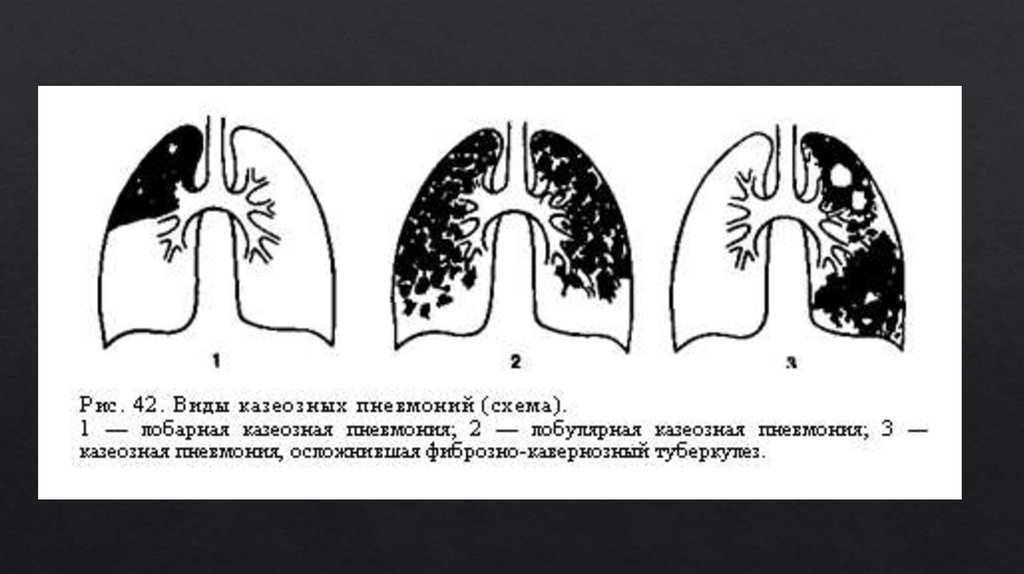 Казеозная пневмония презентация