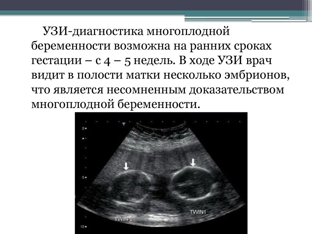 Как отличить на узи. Многоплодная беременность УЗИ. УЗИ критерии многоплодной беременности. УЗИ беременности на ранних. УЗИ беременности на ранних сроках.