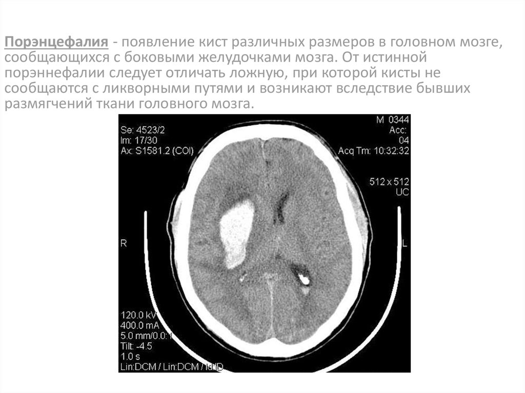 Порэнцефалическая киста