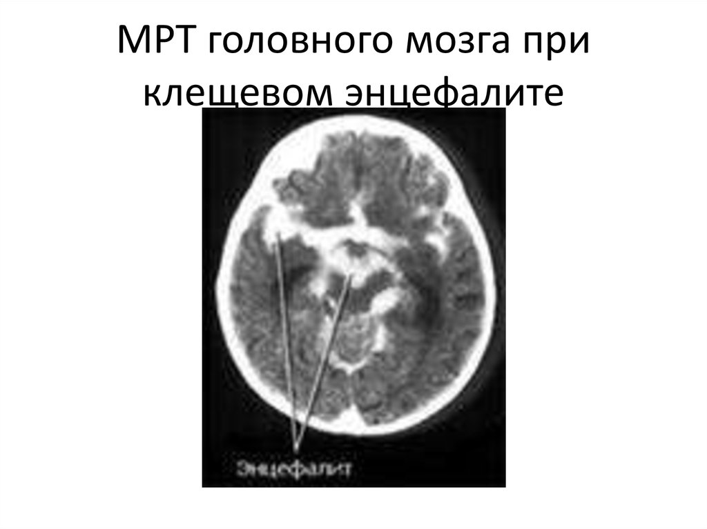 Энцефалит головного мозга у взрослых. Герпетический энцефалит кт. Клещевой энцефалит кт головного мозга. Мрт при клещевом энцефалите.