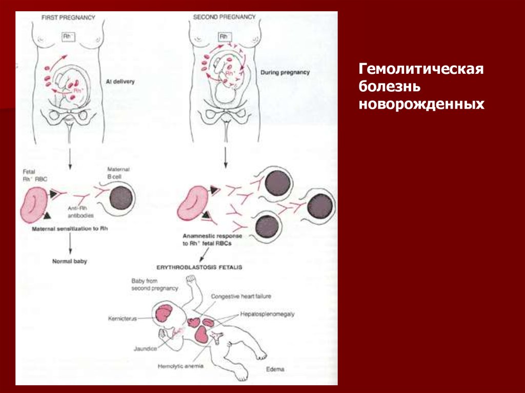 Анемия гемолитической болезни новорожденных. Отечная форма гемолитической болезни плода. Отёчная форма гемолитической болезни новорожденных картинка. Гемолитическая болезнь плода иммунология. Гемолитическая болезнь новорожденных патофизиология.