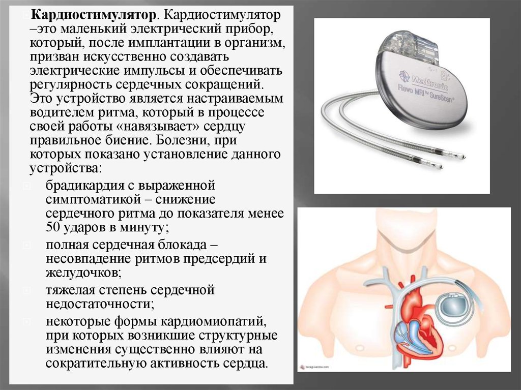 Сколько живут с кардиостимулятором. Кардиостимулятор сердца. Электрокардиостимулятор имплантируемый. Электрический кардиостимулятор.