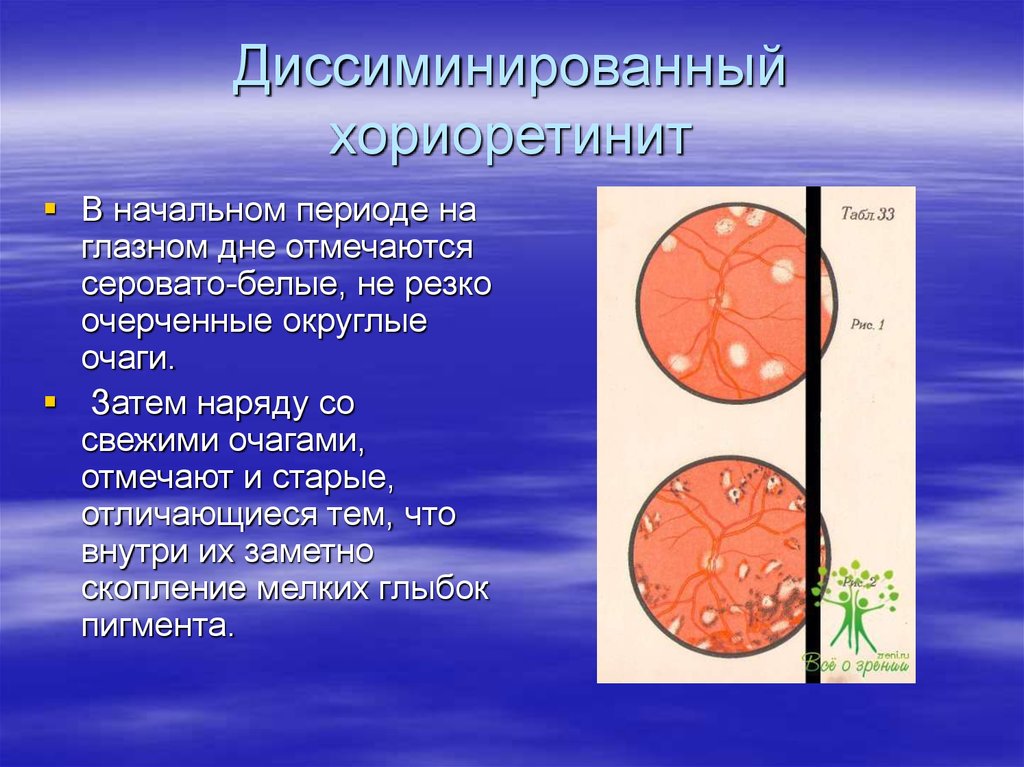 Диссиминированный хориоретинит