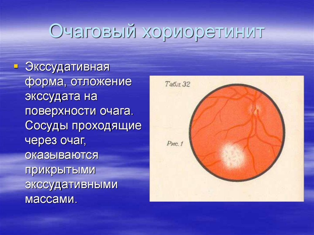 Очаговый хориоретинит