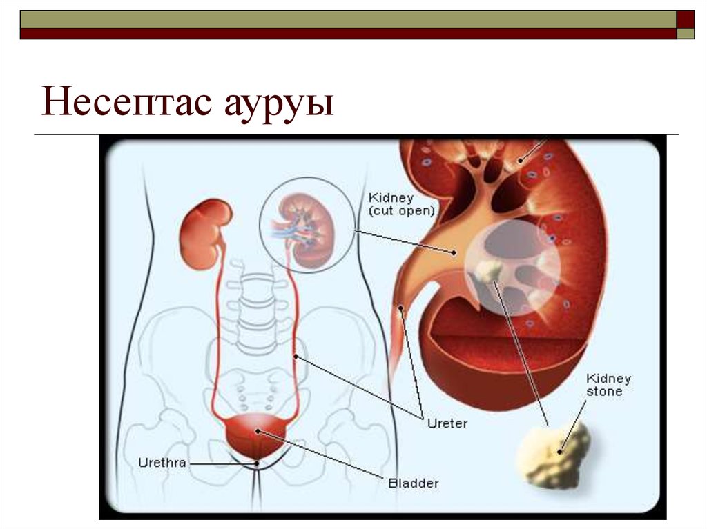 Презентация несеп тас ауруы