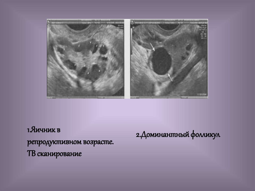 Фолликулы в яичниках что это. УЗИ яичников доминантный фолликул. Доминантный фолликул на УЗИ. Фолликулярная яичника на УЗИ.