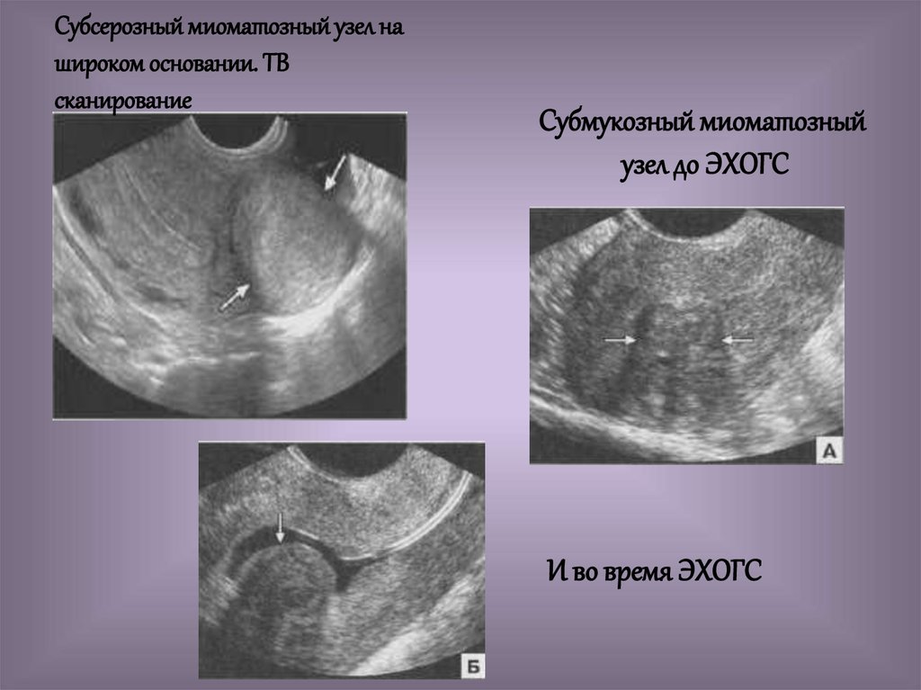 Субмукозная матка. Субмукозная миома матки УЗИ. Субсерозный миоматозный узел на широком основании.