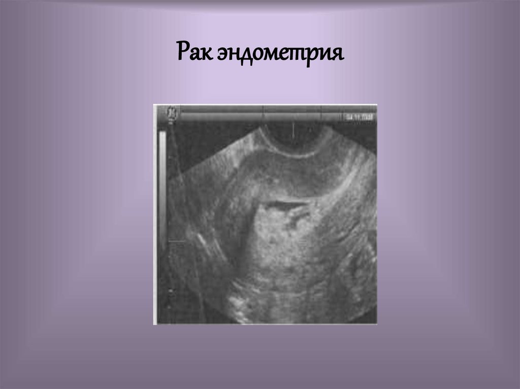 Эндометрия 3 мм