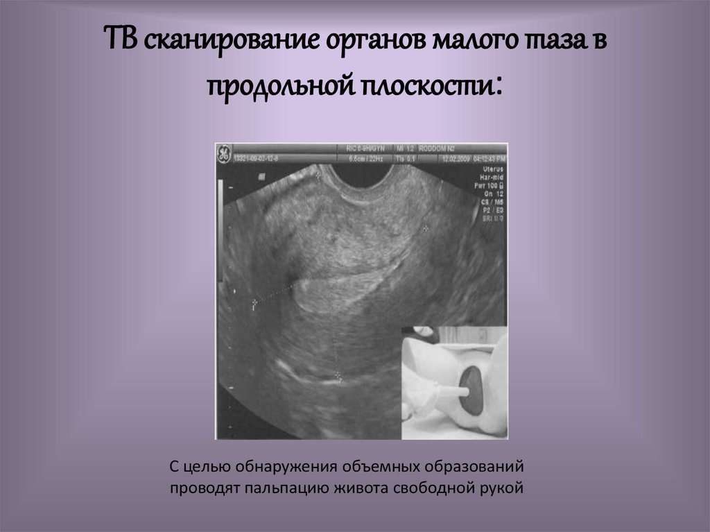 ТВ сканирование органов малого таза в продольной плоскости: